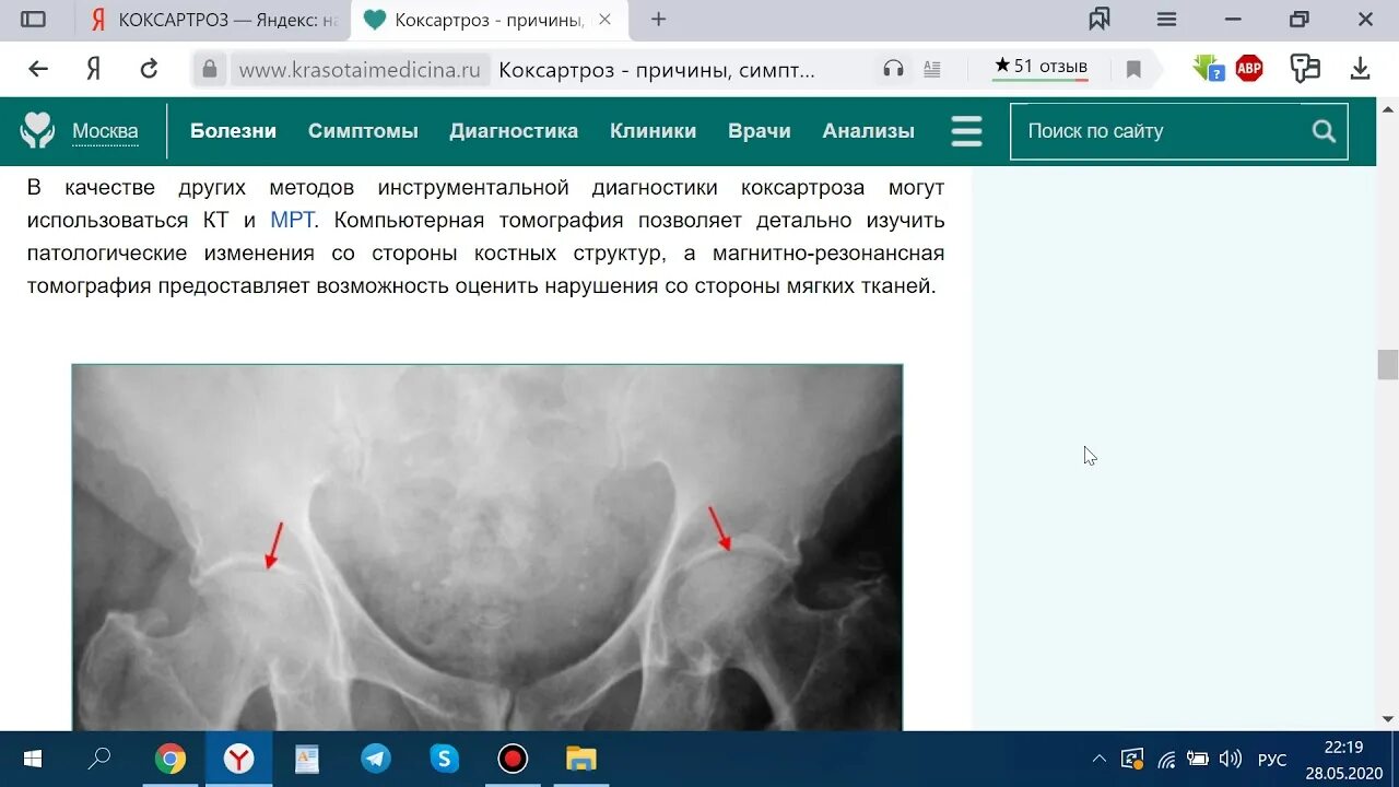 Коксартроз самодиагностика. Коксартроз тазобедренного сустава дифференциальная диагностика. Диагностические критерии коксартроза. Коксартроз к какому врачу обратиться