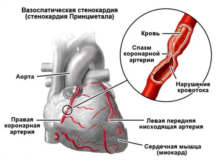 ИБС вазоспастическая стенокардия. Спонтанная (вариантная) стенокардия. ИБС вариантная стенокардия Принцметала. Механизм развития стенокардии Принцметала. Почему спазм сосудов