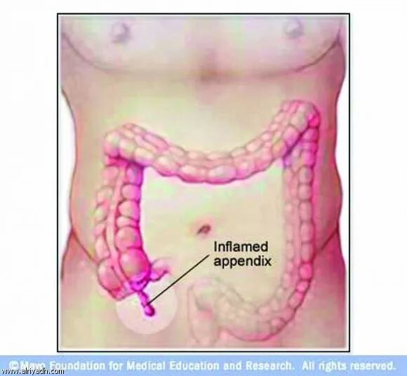 Как понять аппендицит или нет. Где находится аппендикс у человека. Расположение аппендицита у человека.