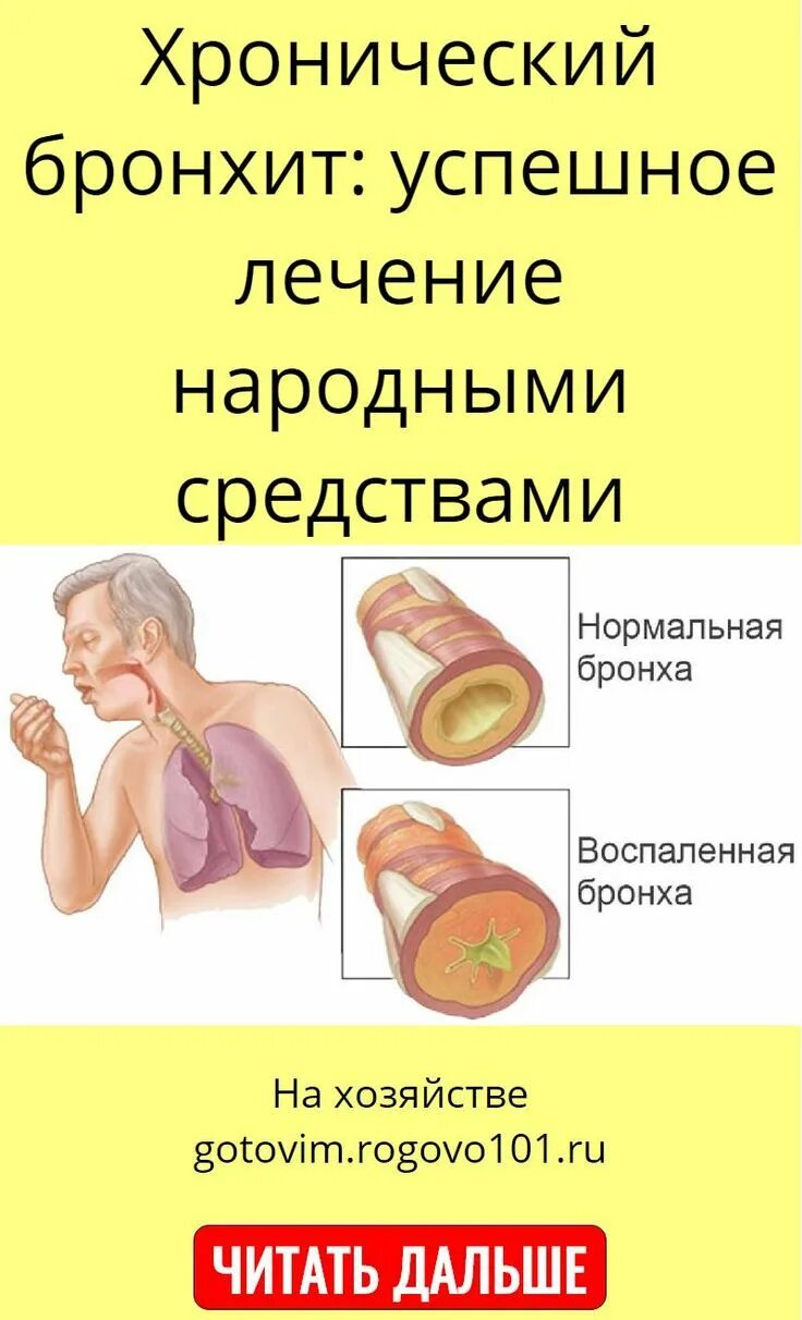 Бронхит народные средства. Народные средства от хронического бронхита. Хронический бронхит народными средствами.