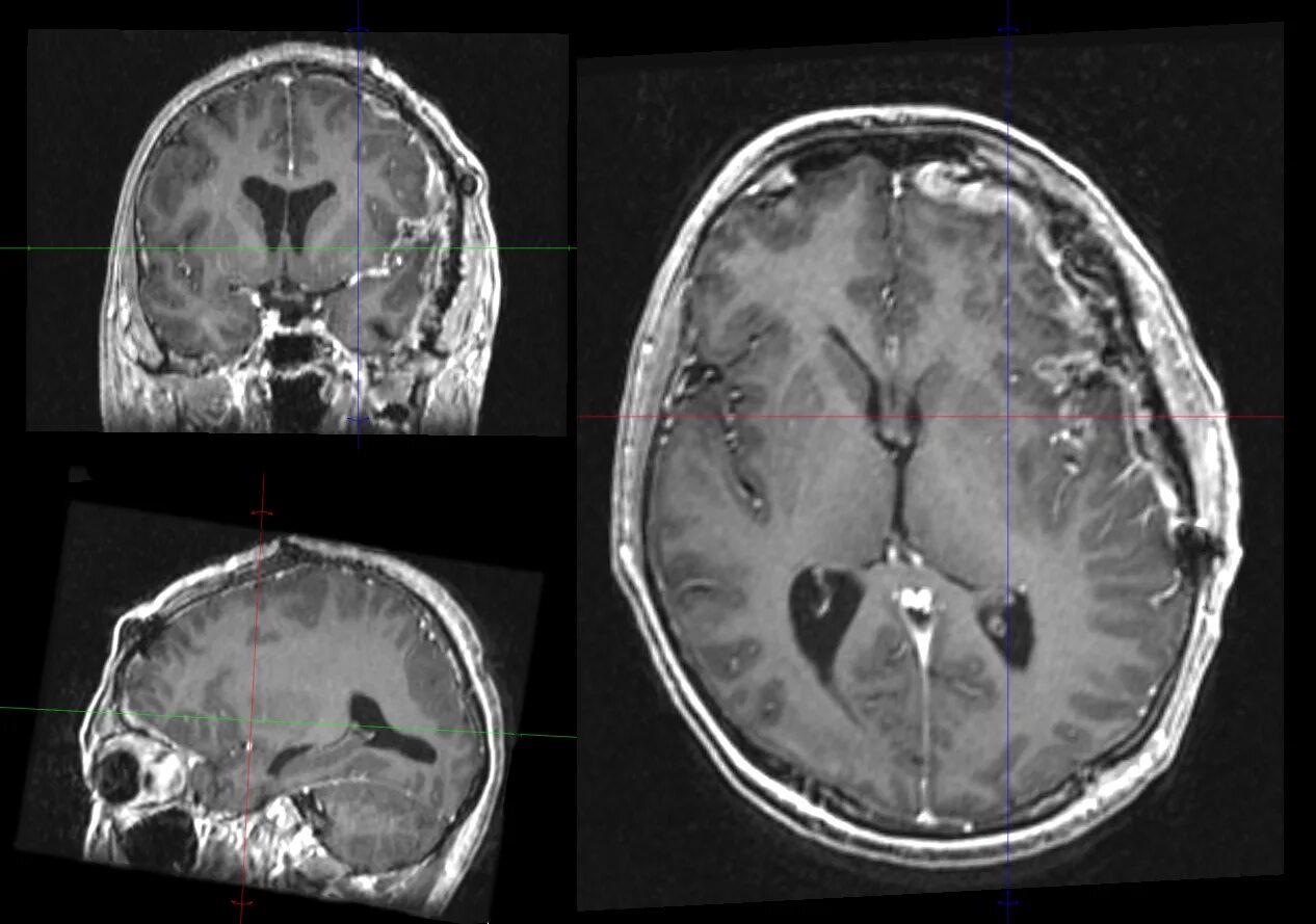 После операции менингиомы головного мозга. Менингиома мозжечка кт. Менингиома лобно-теменной области. Мрт.. Петрифицированная менингиома. Менингиома мозжечка мрт.