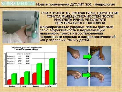 Мышцы после инсульта