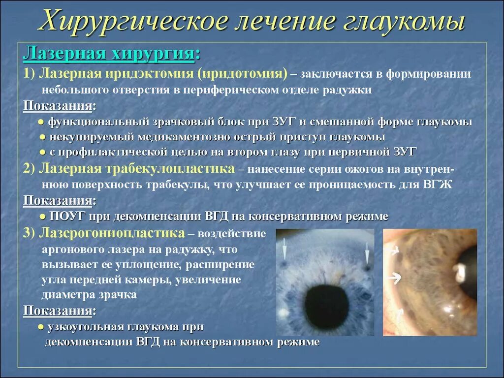 Что можно делать после катаракты. Лазерная периферическая иридэктомия (глаукома). Первичная глаукома симптомы. Хирургическое лечение глаукомы. Основные симптомы глаукомы.