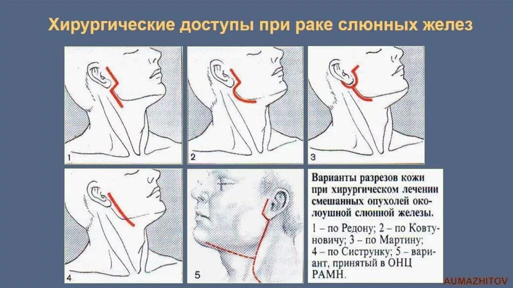 Операции околоушная железа