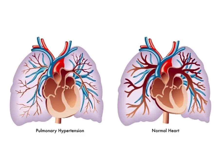 Легочная гипертензия. Легочная артериальная гипертензия. Легочная гипертензия и легочное сердце. Что такое легочная гипертензия сердца.
