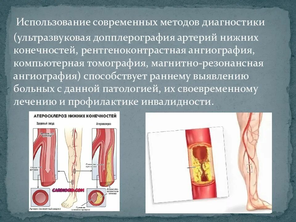 Заболевания артериальных сосудов. Заболевания вен и артерий. Облитерирующий атеросклероз артерий нижних конечностей. Атеросклеротическое поражение артерий нижних конечностей.