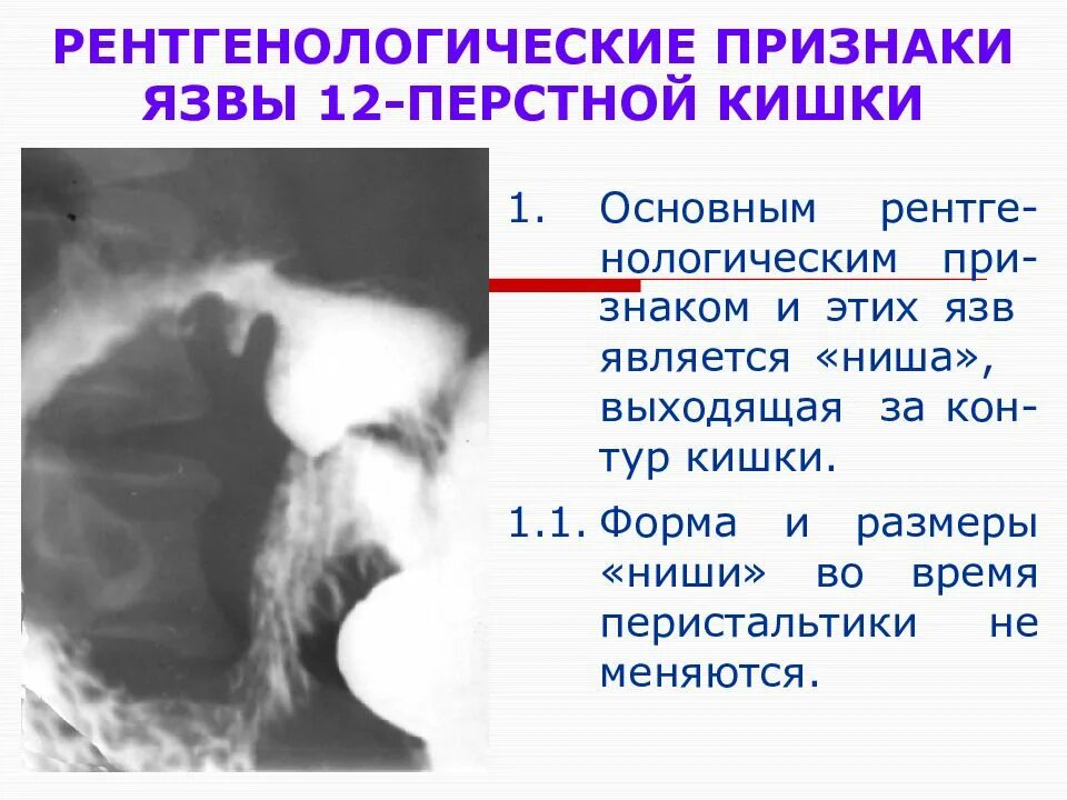 Язвенная болезнь 12 перстной кишки рентген. Рентген язвы желудка симптом ниши. Язва 12 перстной кишки рентген. Рентгенологические признаки язвы. Мкб 10 язва 12 перстной кишки