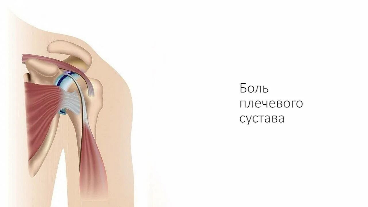 Сильная боль в плечевом суставе