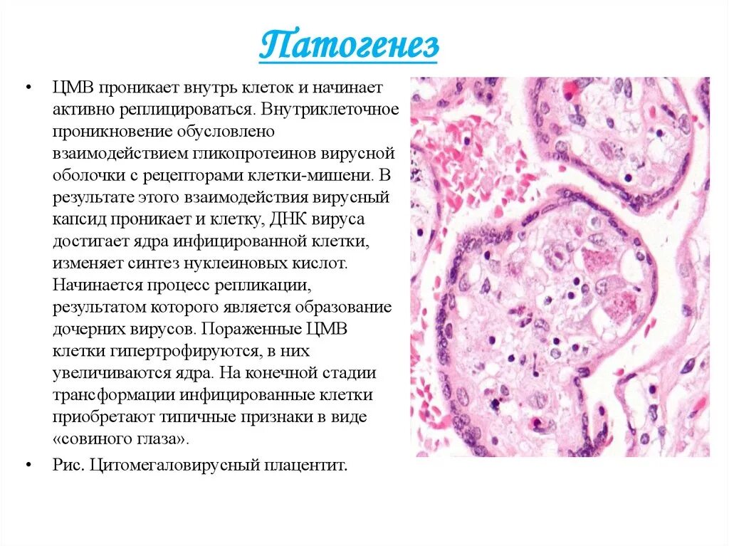 Гистология при беременности. Патогенез цитомегаловирусной инфекции. Цитомегаловирусный сиалоаденит микропрепарат описание. Цитомегаловирусный сиалоаденит микропрепарат. ЦМВ пневмония микропрепарат.