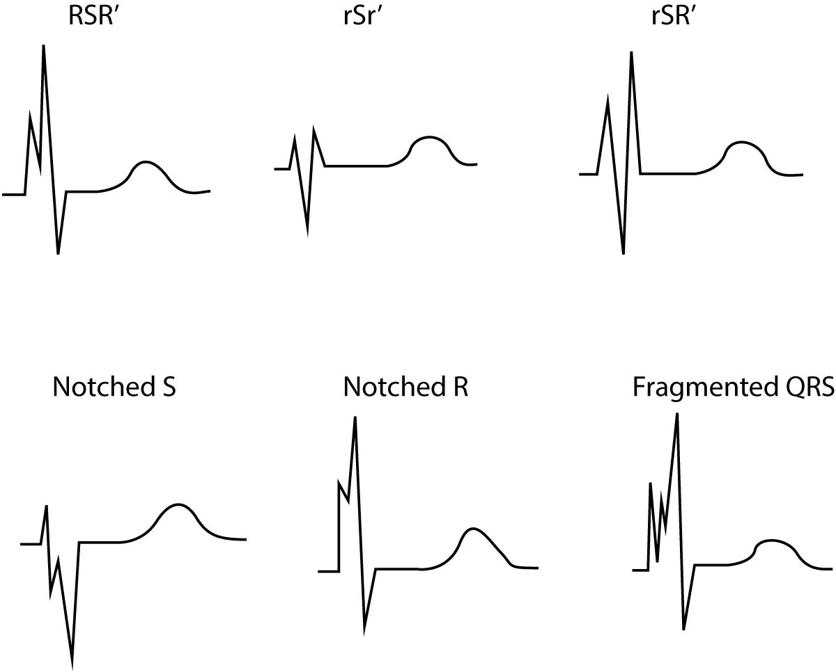 Qrs на экг что это. Фрагментация QRS на ЭКГ. Комплекс QRS на ЭКГ. Myocardial infarction ECG. Высокий комплекс QRS на ЭКГ.