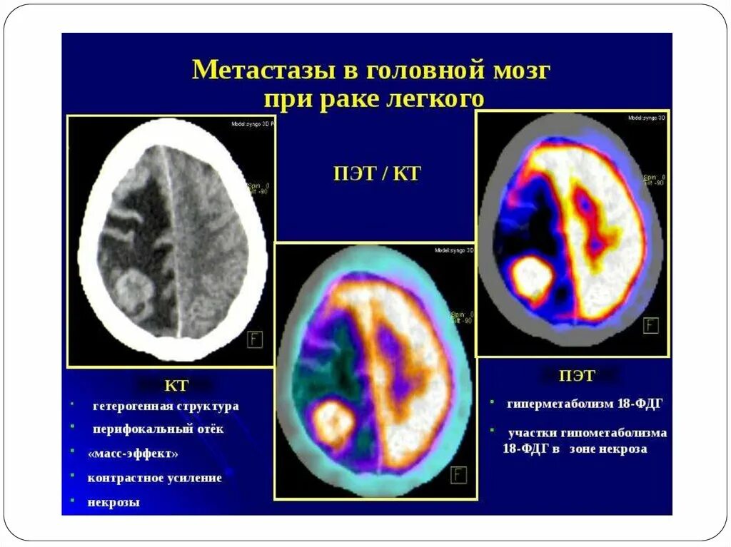 Метастатические опухоли мозга. Метастаз в головном мозге кт мрт. Метастазы головного мозга кт. Метастазирование опухолей головного мозга.