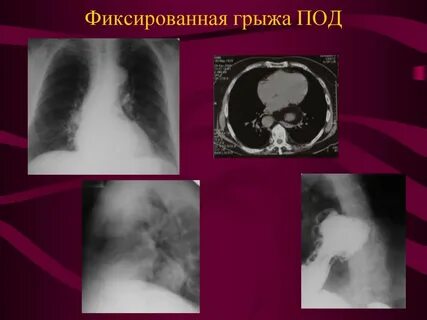 Грыжа под