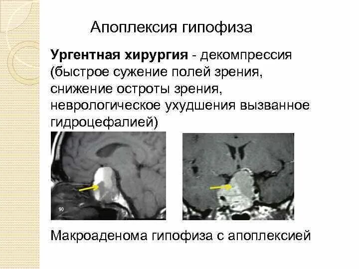 Макроаденома гипофиза. Кровоизлияние в гипофиз кт. апоплексия гипофиза мрт. апоплексия аденомы гипофиза.