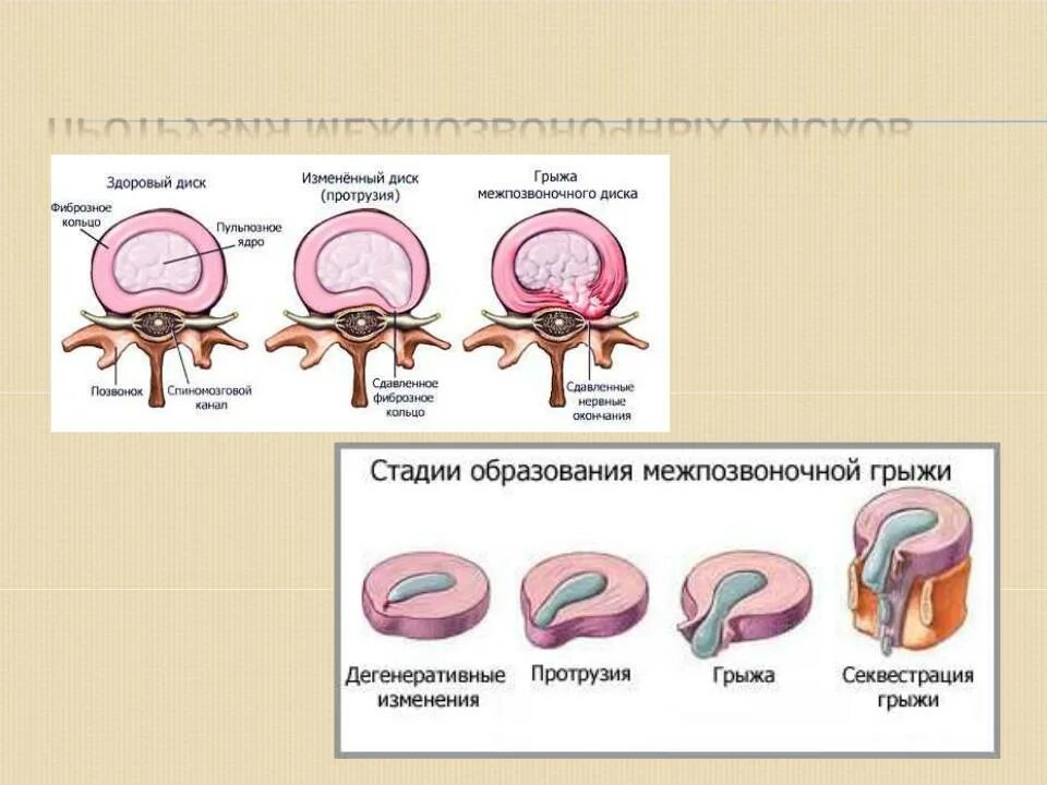 Протрузия грыжа секвестрация. Секвестрированная грыжа на кт. Секвестрация межпозвонкового диска.