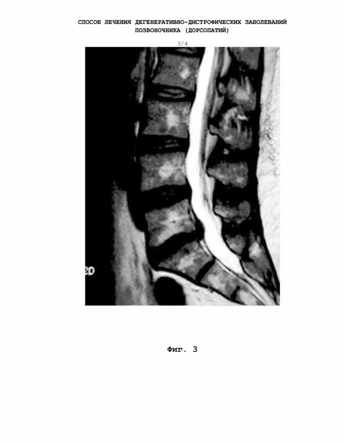 Дистрофические изменения позвоночника. Дегенеративные изменения пояснично-крестцового отдела позвоночника. Дегенеративно дистрофические поражения позвоночника Труфанов. Дегенеративно-деструктивные поражения позвоночника. Дегенеративно дистрофические изменения l3-l5.