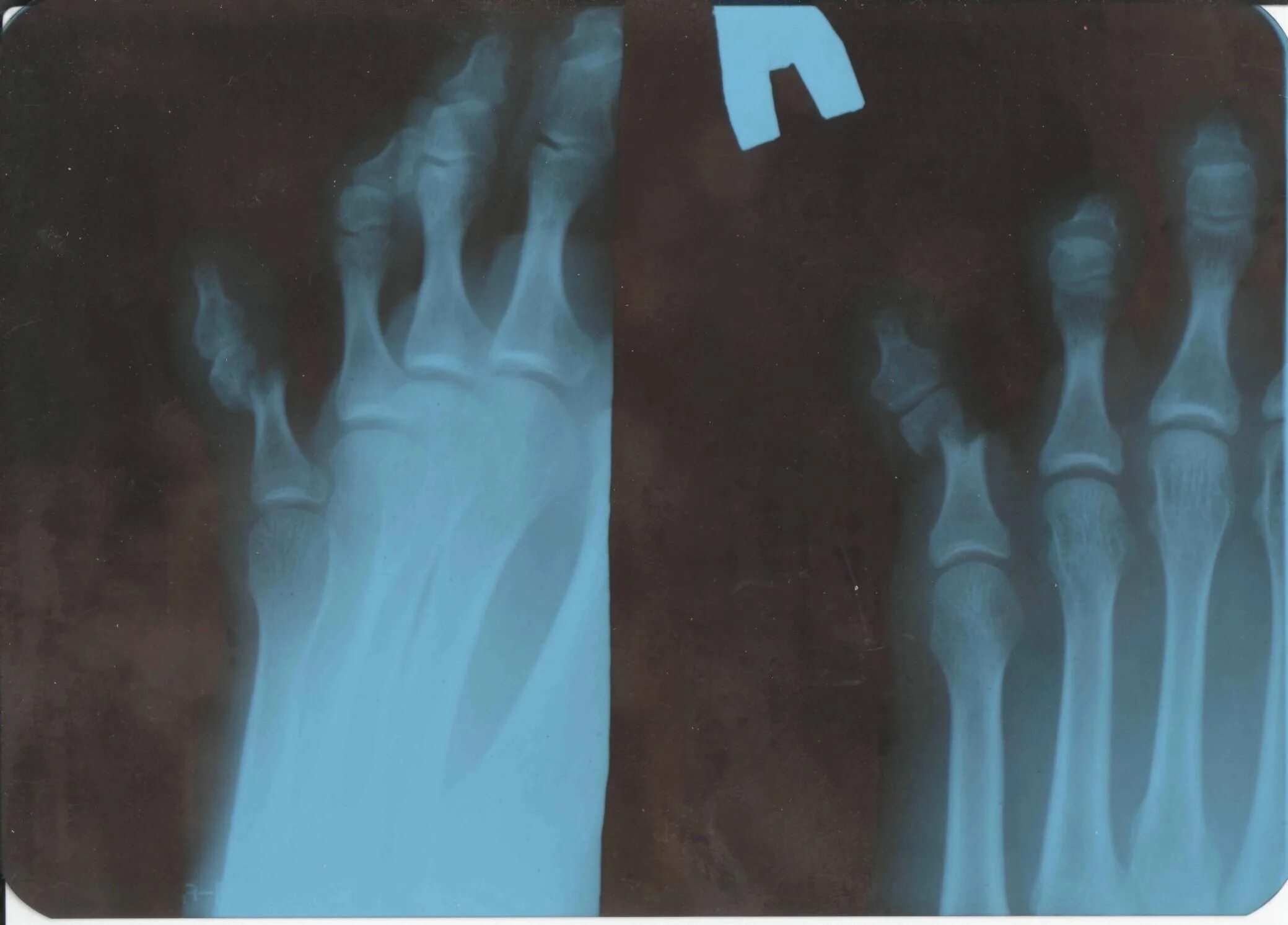 Оскольчатый перелом пальца ноги рентген. Перелом мизинца рентген снимок. Перелом мизинца на ноге рентген снимок. Перелом мизинца на ноге рентген. Не заметил перелом