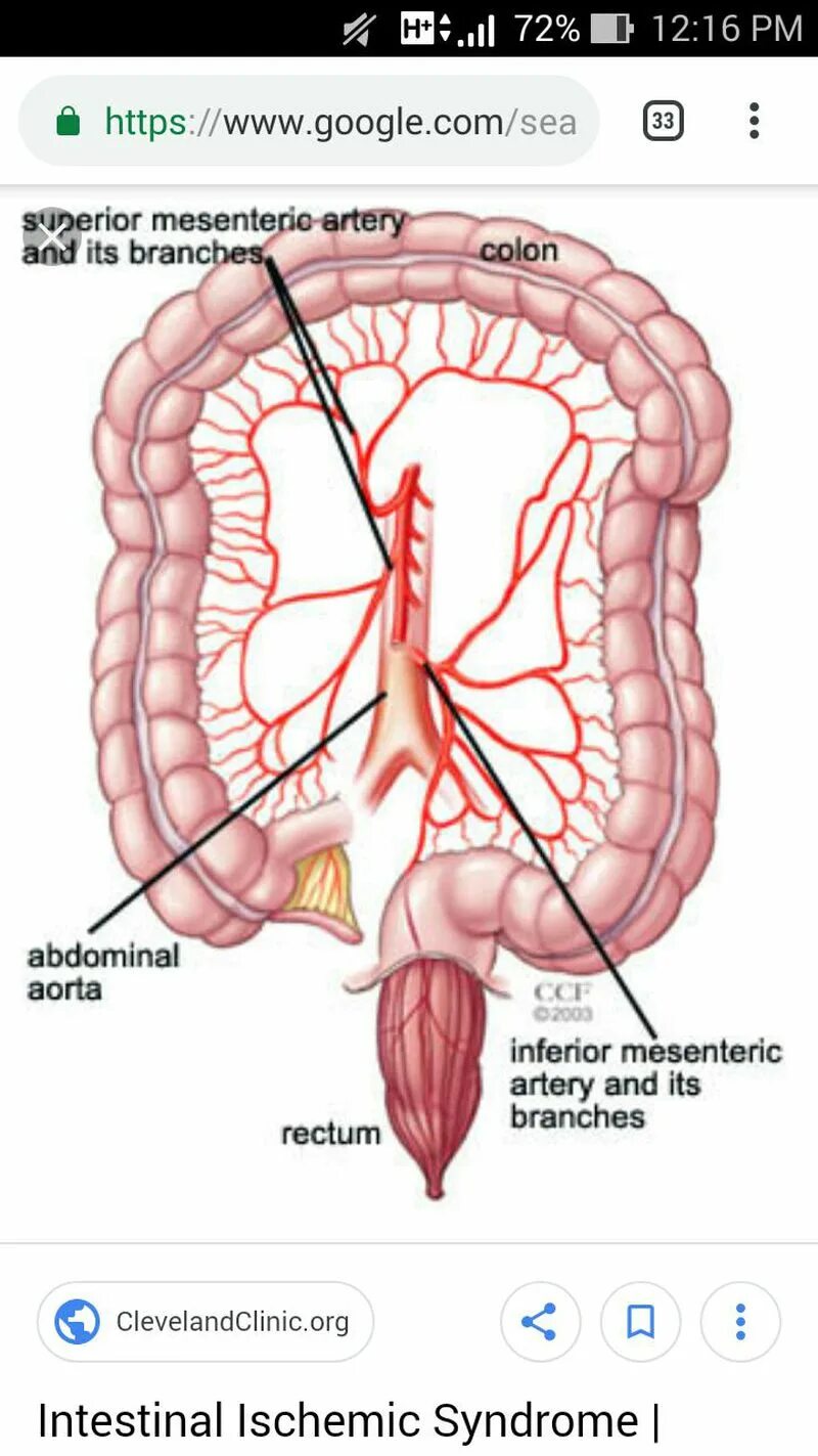 Острое мезентериальное кровообращение. Мезентериальная брыжейки. Мезентериальные сосуды атеросклероз. Мезентериальная эмболия ишемия кишечника. Тромбоз мезентериальных вен.