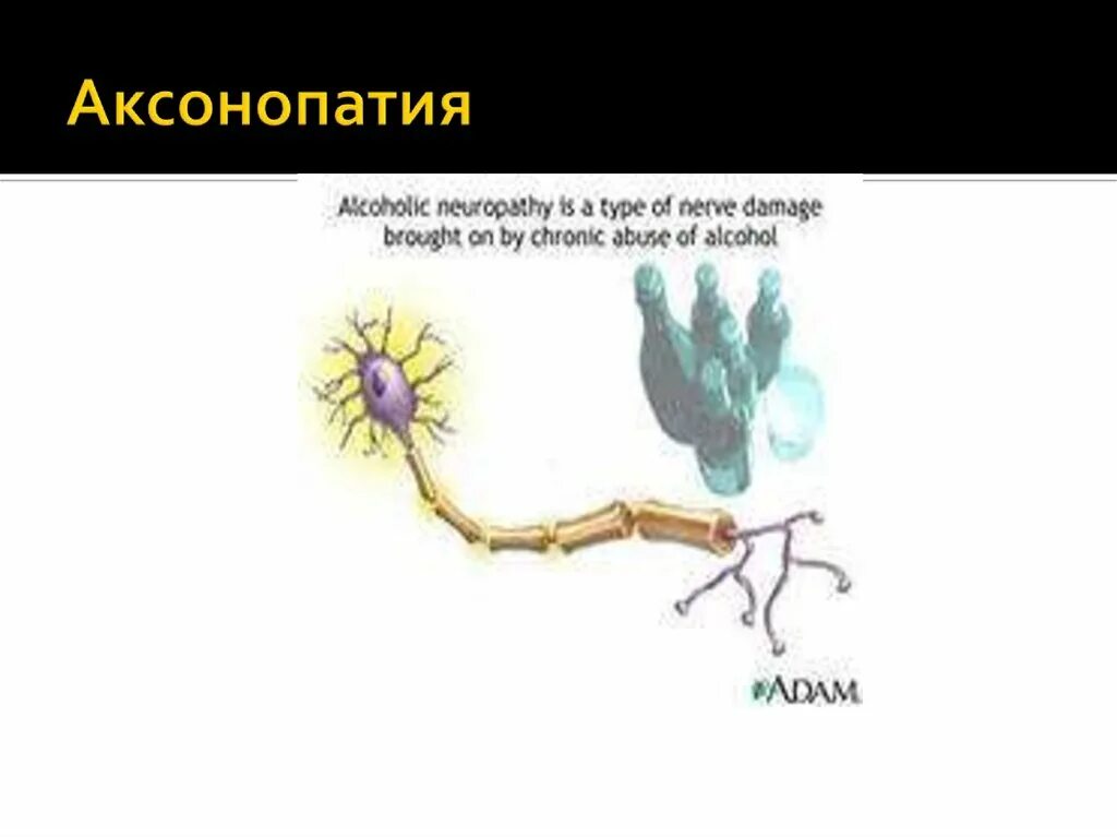 Аксонопатия. Аксонопатия и миелинопатия. аксональные полиневропатии. аксональная дегенерация.