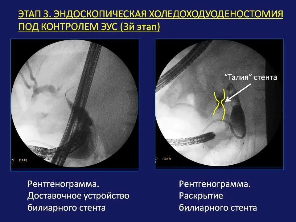 Эус желудка. Холедоходуоденостомия. Холедоходуоденоанастомоз по Финстереру. Эндоскопический стент.