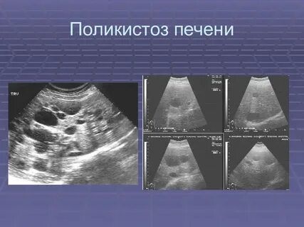 Поликистоз печени