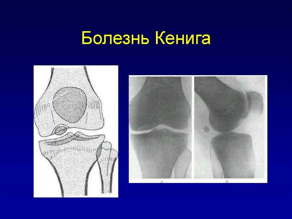 Болезнь кенига коленного сустава кт. Остеохондропатия кенига. Остеохондропатия бедренной кости кенига. Остеохондропатия коленного сустава кенига. Болезнь кёнига рассекающий остеохондрит.