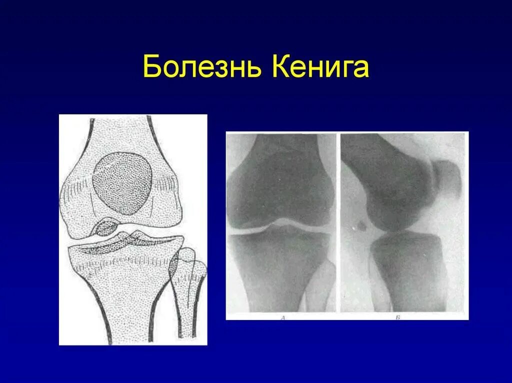 Остеохондропатия надколенника (болезнь Синдинга-Ларсена). Асептический некроз мыщелков бедренной кости рентген. Остеохондропатии Кенига. Суставная мышь коленного сустава рентген.