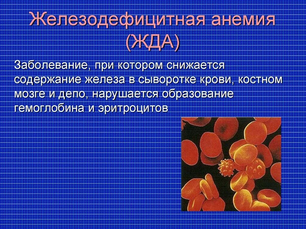 Анемия больные. Жда анемия. Железодефицитная анемия это заболевание. Железо анемия. Презентация на тему железодефицитная анемия.