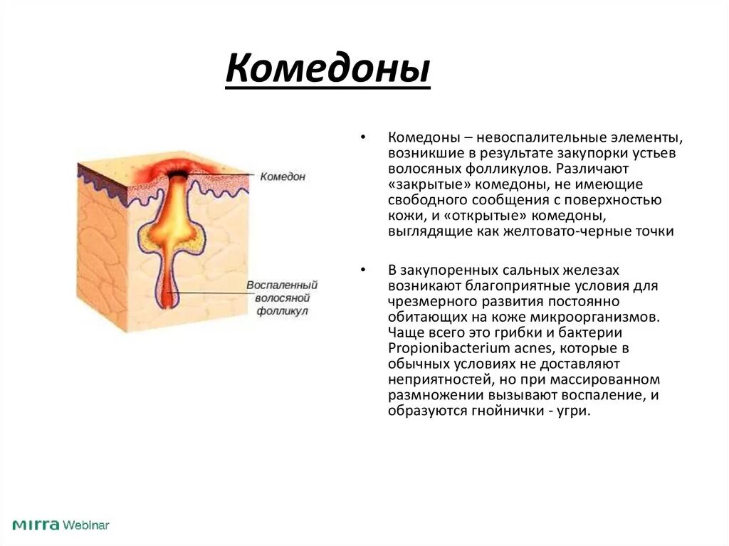 Текст про угрей. Комедоны схема волосяной фолликул. Открытые и закрытые комедоны.