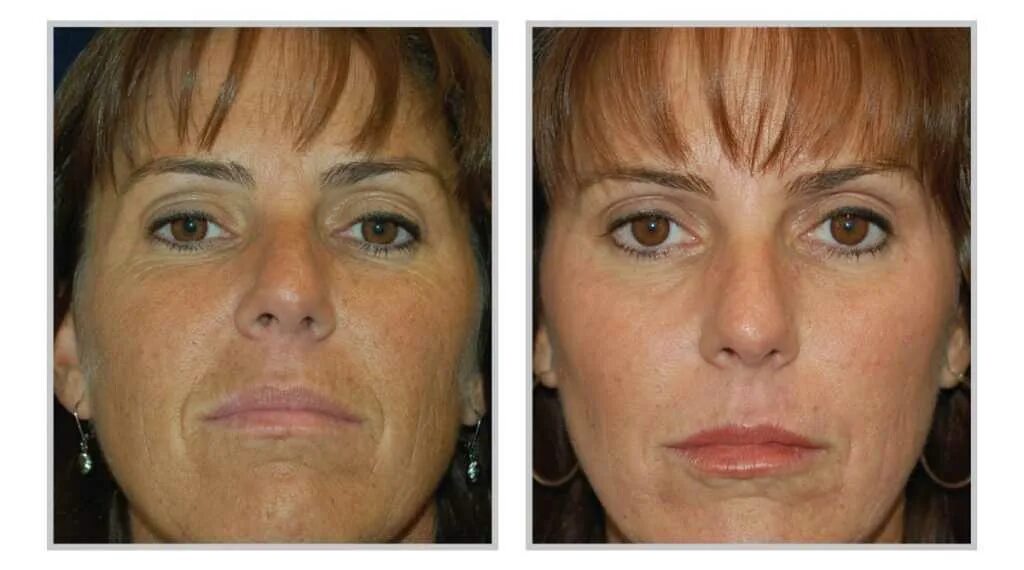Дряблость кожи лица. Фраксель лазерная шлифовка век. Подтяжка кожи лица. Обвисшие щеки. Кожа лица становится дряблой что делать.