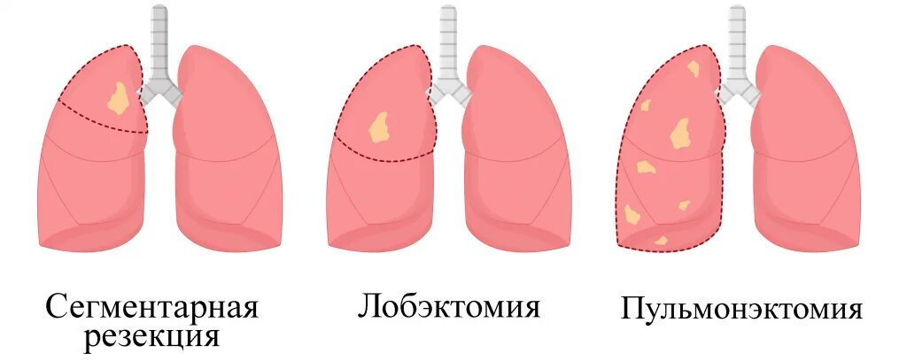 Лобэктомия и пневмонэктомия. Лобэктомия легкого при туберкулезе. Лобэктомия что это