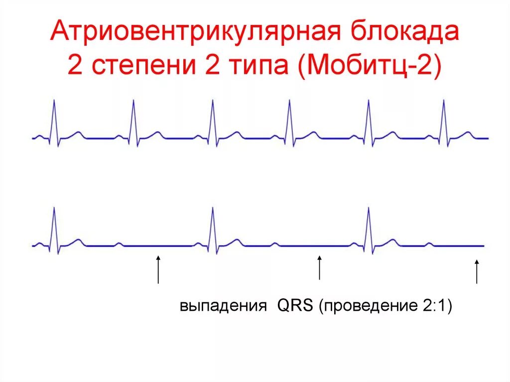 Блокада 2 типа. Ав блокада мобитц 2 на экг. ав блокада 2 степени мобитц 2 на экг. ав блокада 2 степени тип мобитц 2. экг атриовентрикулярная блокада мобитц 2.