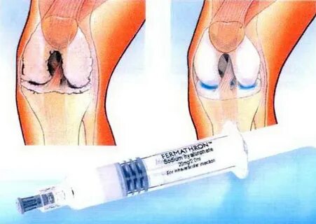 Укол для смазки суставов