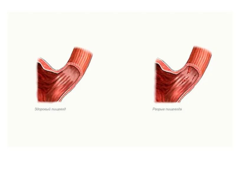 Синдром Мэллори Вейса картинки. Спонтанный разрыв пищевода синдром Бурхаве. Поврежденный пищевод