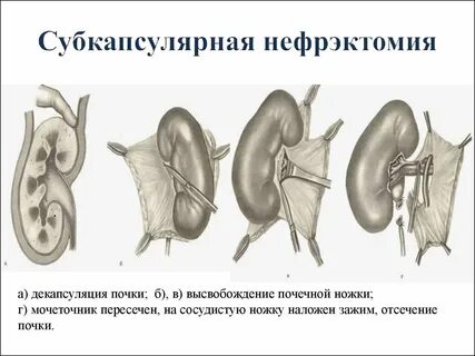 Удаление правой почки