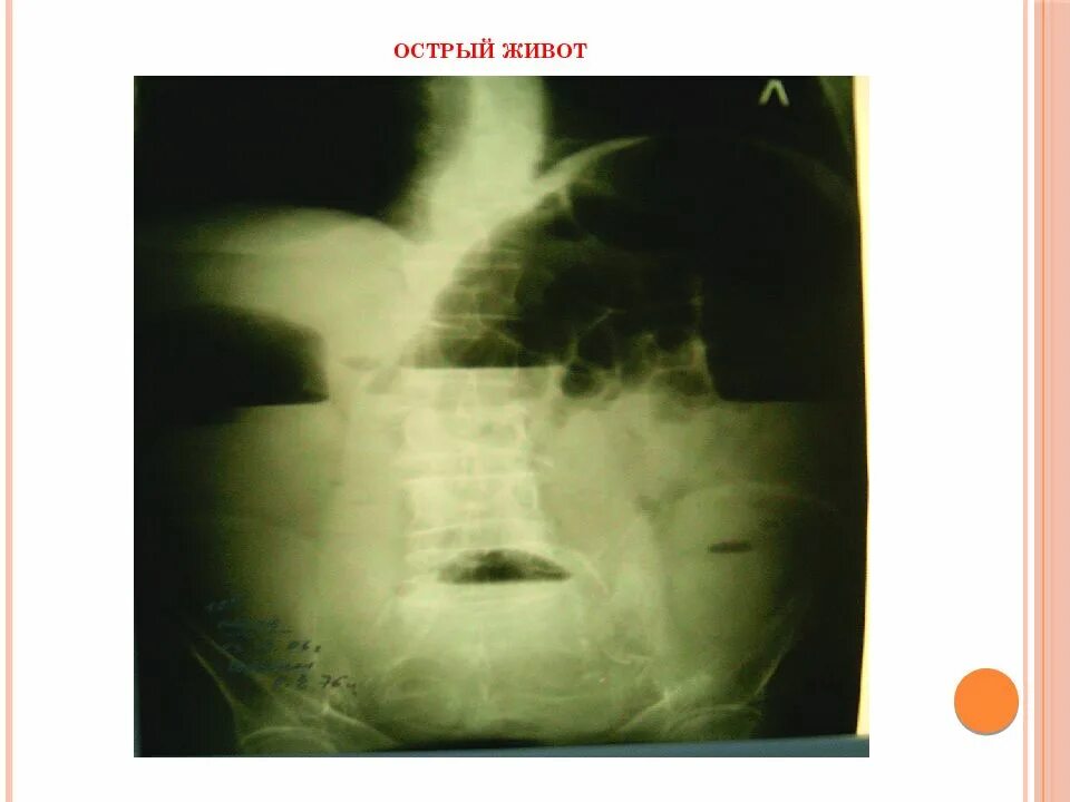 Острый живот операция. Острый живот. Симптомокомплекс острого живота.
