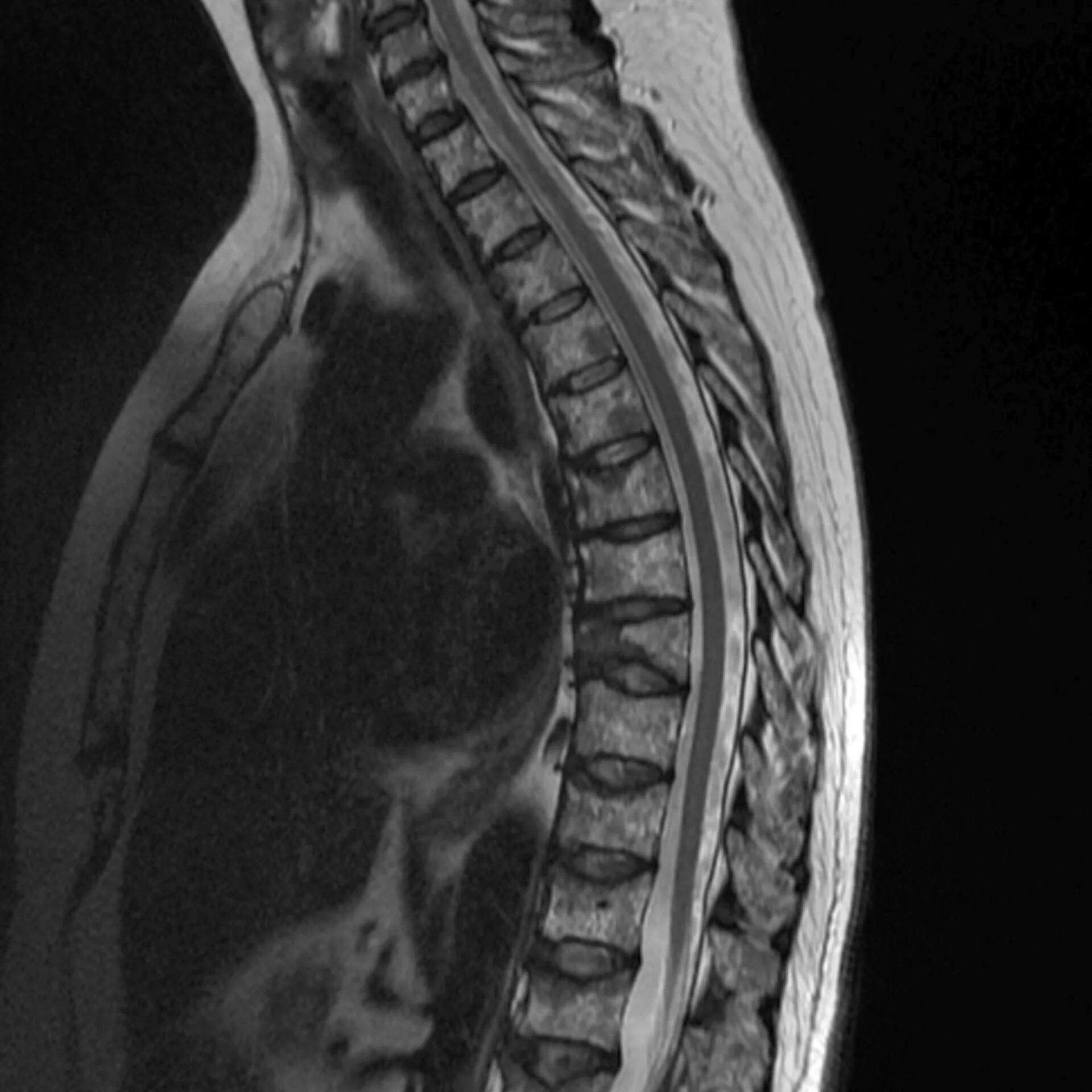 Эпендимома спинного. Мрт спинного мозга грудной отдел. Мрт спинного мозга грудного отдела позвоночника. Кифоз грудного отдела позвоночника мрт. Мрт грудного отдела et33.