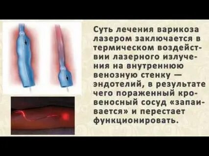 Гепариновая при варикозе отзывы