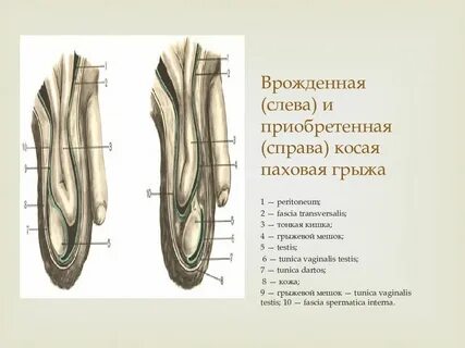 Косая паховая грыжа
