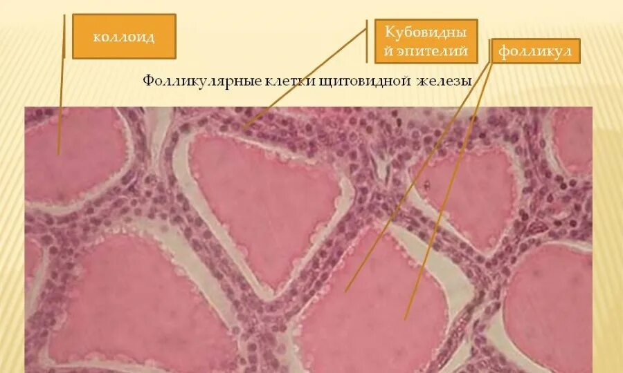 Фолликул щитовидной железы что это. Щитовидная железа гистология препарат. Клетки щитовидной железы гистология. Коллоидный пролиферирующий зоб. Коллоидный зоб гистология.