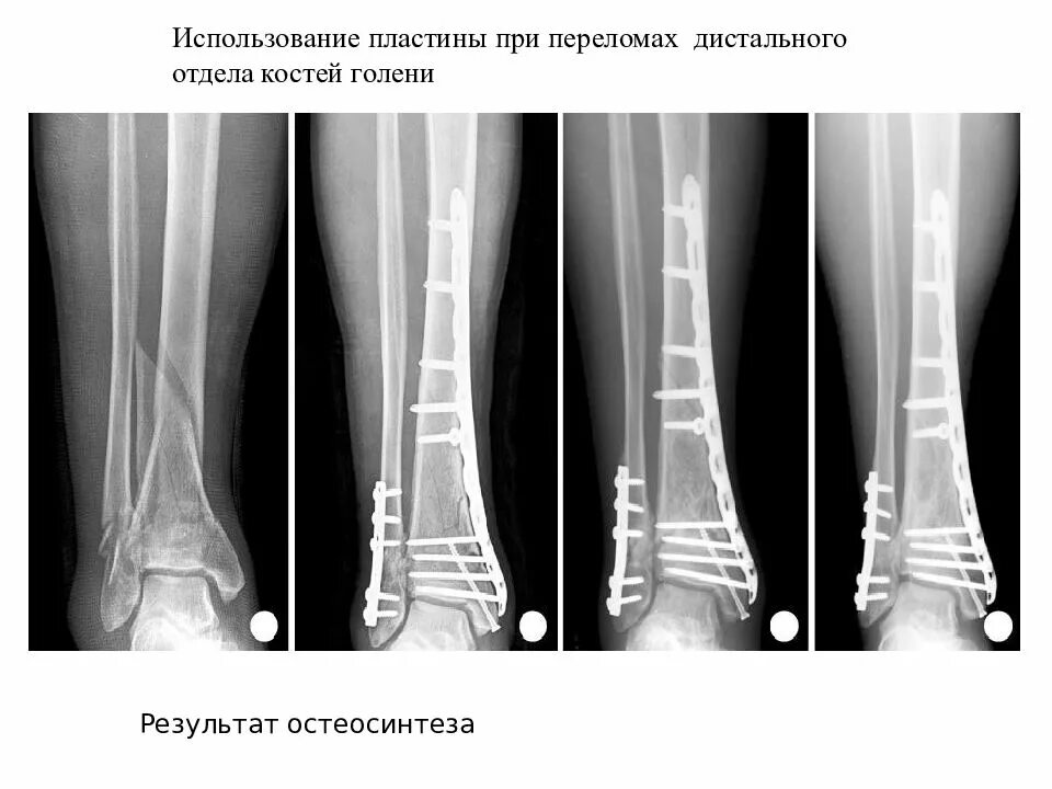 Лечение после переломов костей. Остеосинтез перелома берцовой кости. Экстрамедуллярный остеосинтез. Оскольчатый перелом большеберцовой кости рентген. Остеосинтез лодыжки пластиной рентген.