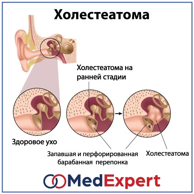 Хронический Гнойный эпитимпанит. Хронический Гнойный средний отит отоскопия. Хр Гнойный отит барабанная перепонка. Врожденная холестеатома барабанная перепонка. Положение барабанной перепонки