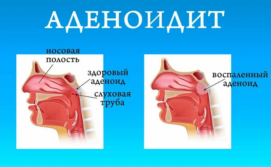 Аденоиды признаки. Строение носоглотки аденоиды. Носоглотка воспаление аденоиды. Анатомия носоглотки аденоиды. Аденоиды носоглоточные миндалины.