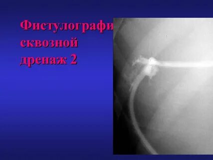 Фистулография