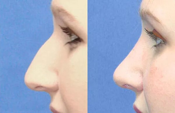 Ринопластика горбинки носа. Костно хрящевая горбинка носа. Нос без горбинки. Упражнения для горбинки на носу.