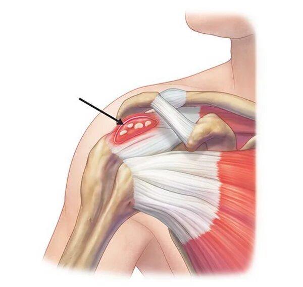Травмы мышц и сухожилий. Ротаторная манжета плечевого сустава. Ротаторная манжета плеча тендинит. Кальцифицирующий тендинит. Ротаторная манжета плечевого сустава разрыв.