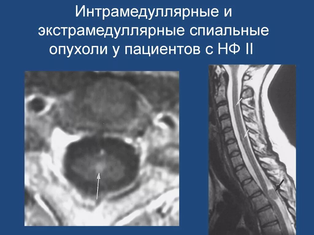 Экстрамедуллярная опухоль спинного мозга. Экстрамедуллярная опухоль спинного мозга мрт. Интрамедуллярное объемное образование. Интрадурального экстрамедуллярного объемного образования. Интрамедуллярные опухоли спинного