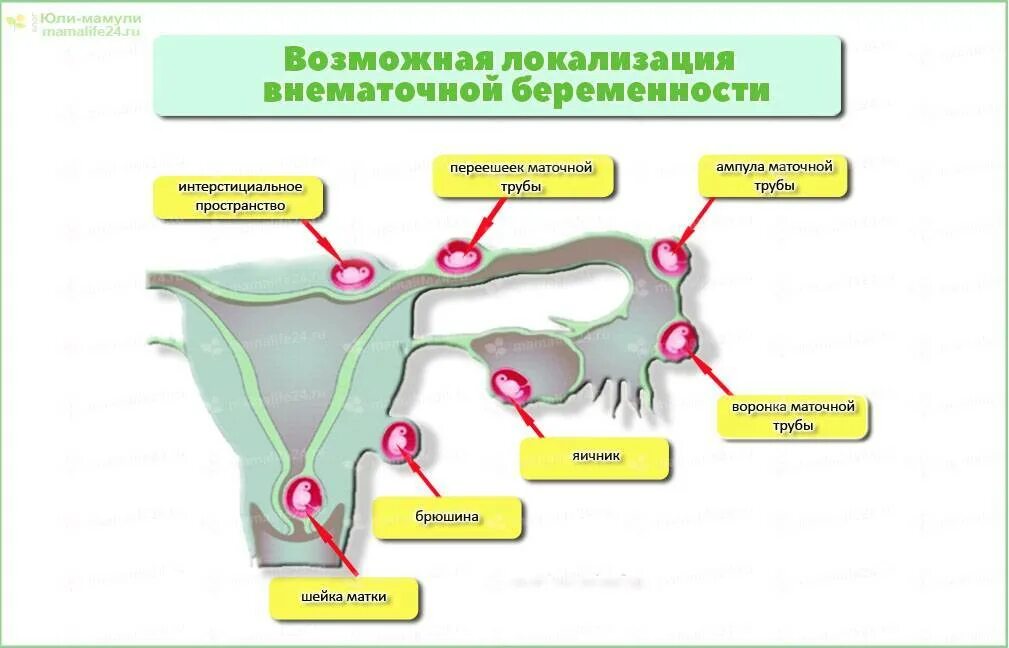 Перевязаны трубы можно ли забеременеть естественным путем. Ампулярная внематочная беременность. Клиническая классификация внематочной беременности. Эктопическая Трубная беременность. Внематочная беременность трубный разрыв.