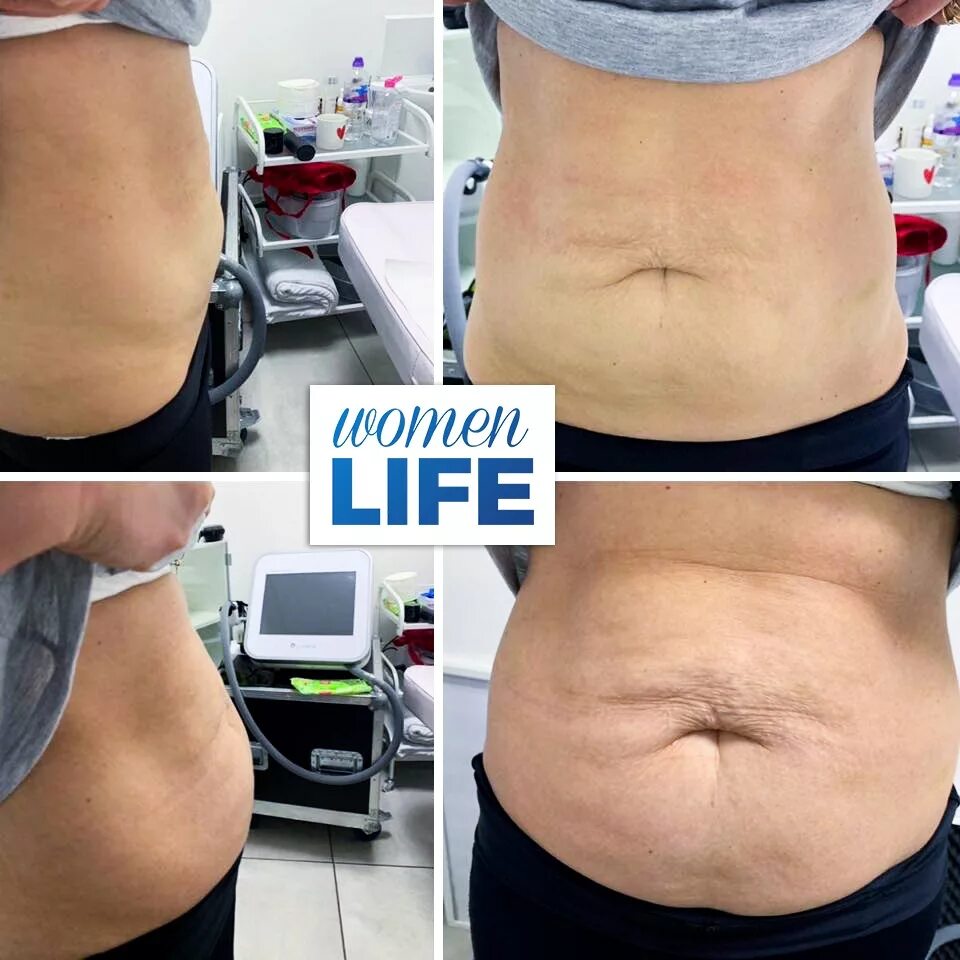 Липолиз ульфит. Ulfit липосакция отзывы. Ulfit липосакция отзывы. Безоперационная липосакция ультразвуком. Ulfit липосакция отзывы.