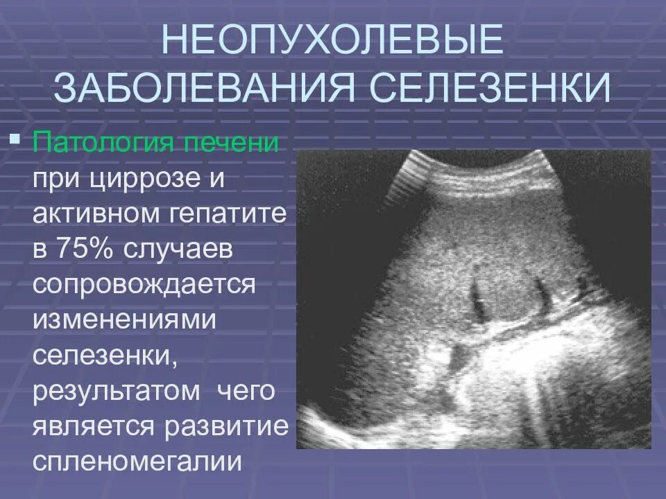 Слабости селезенки. Спленомегалия заболевания. Аномалии развития селезенки. Патология селезенки симптомы. Аномалия формы селезенки.