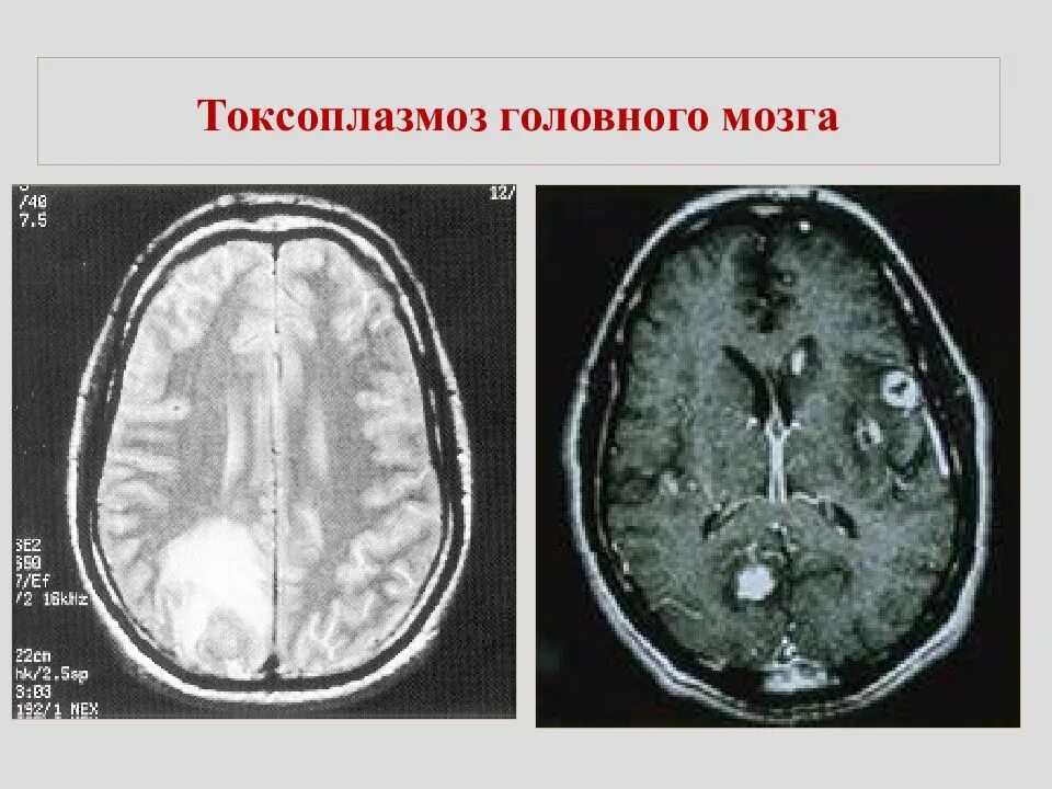 Токсоплазмоз у вич инфицированных. Гидроцефалия токсоплазмоз. врожденный токсоплазмоз. токсоплазмоз кт головы.